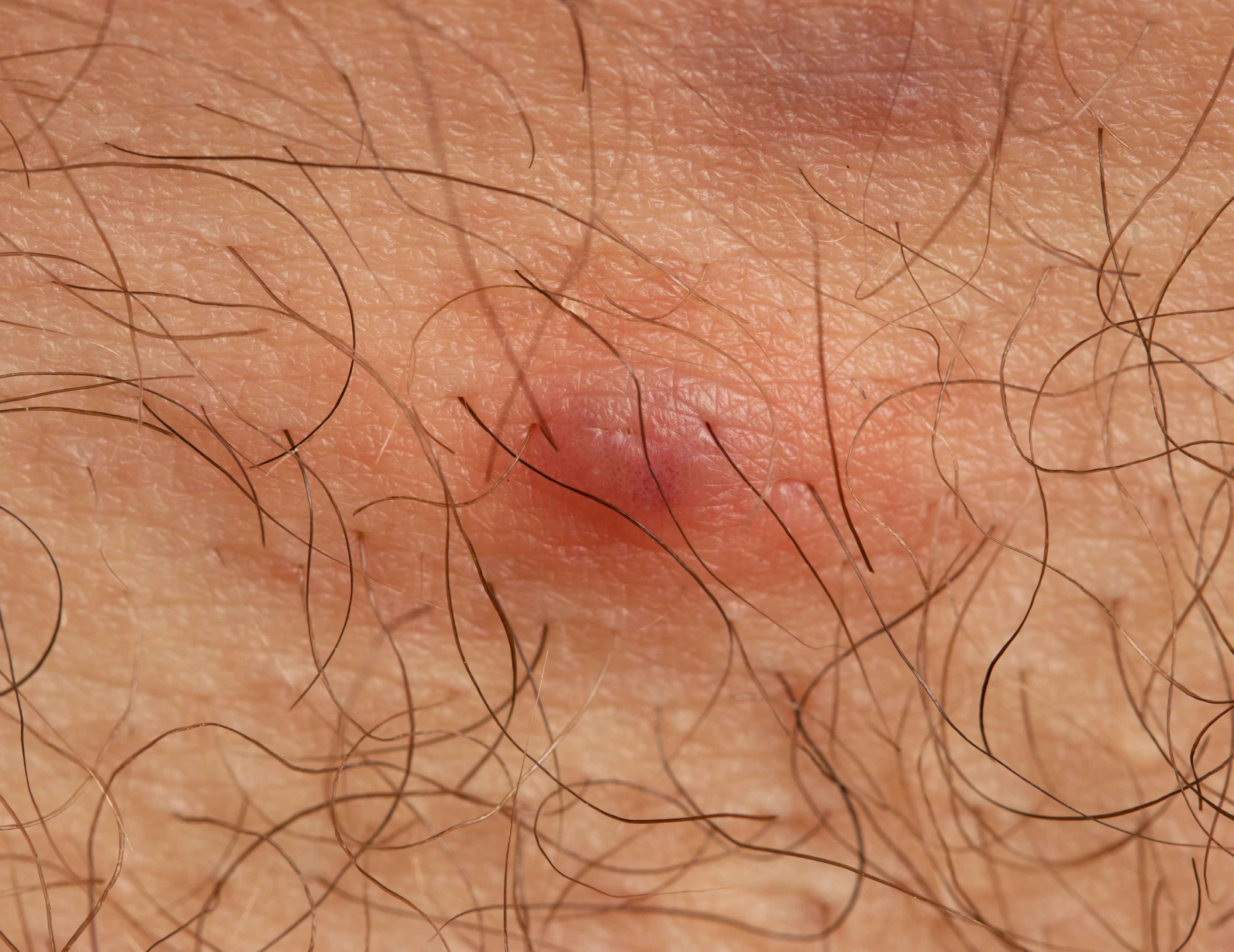 私处这又痒又痛的痘痘是怎么回事？或是衣服惹的祸